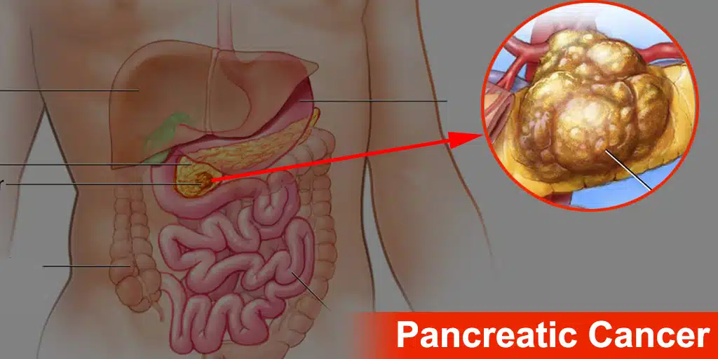 New research reveals how pancreatic cancer hides from the immune system